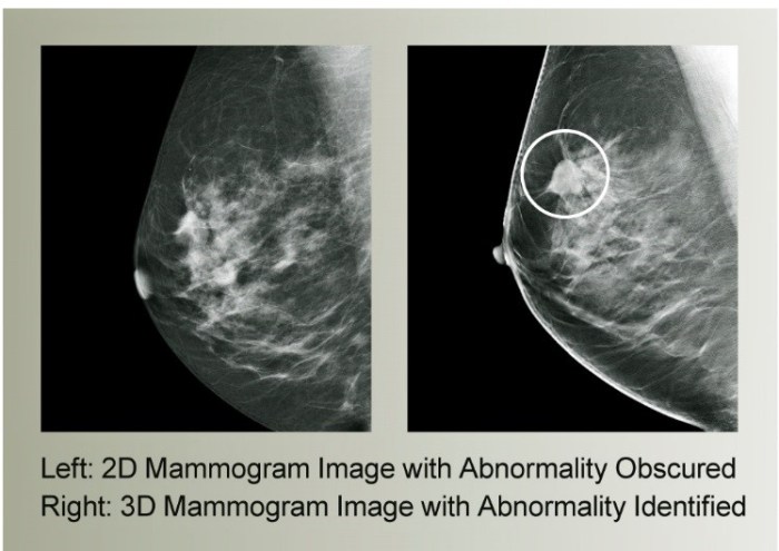 The root type assigned for a mammography is