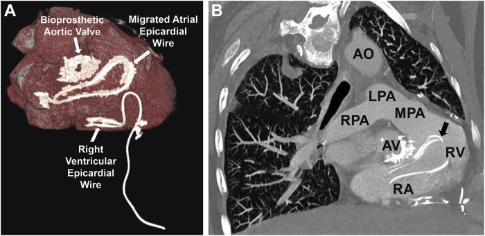 Epicardial pacing retained ahajournals