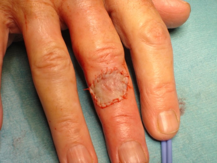 Cpt full thickness skin graft