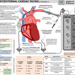 Epicardial wires removal chest pain