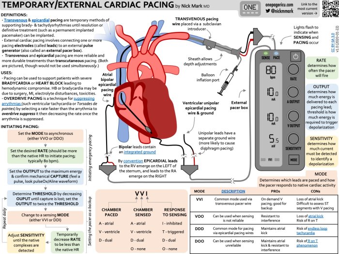 Epicardial wires removal chest pain