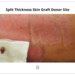 Cpt full thickness skin graft