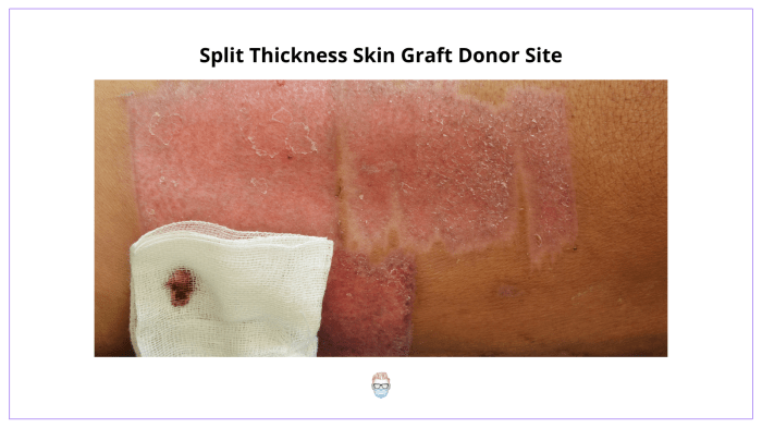 Cpt full thickness skin graft