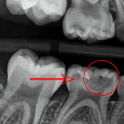 Caries classifications hygienist tooth teeth classification severe incipient dentistryiq radiologia interproximal moderate lesion severity odontologica assistant enamel dentist studentrdh dentin