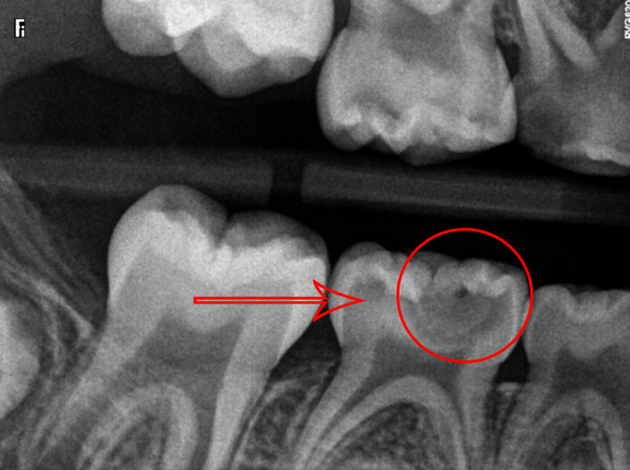 Caries classifications hygienist tooth teeth classification severe incipient dentistryiq radiologia interproximal moderate lesion severity odontologica assistant enamel dentist studentrdh dentin