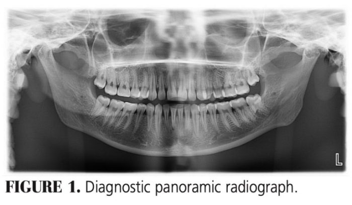 Dental caries assistant xray radiologia odontologica cavity rays cavities hygiene dentista everypost hygienist implant odontológico megan oral